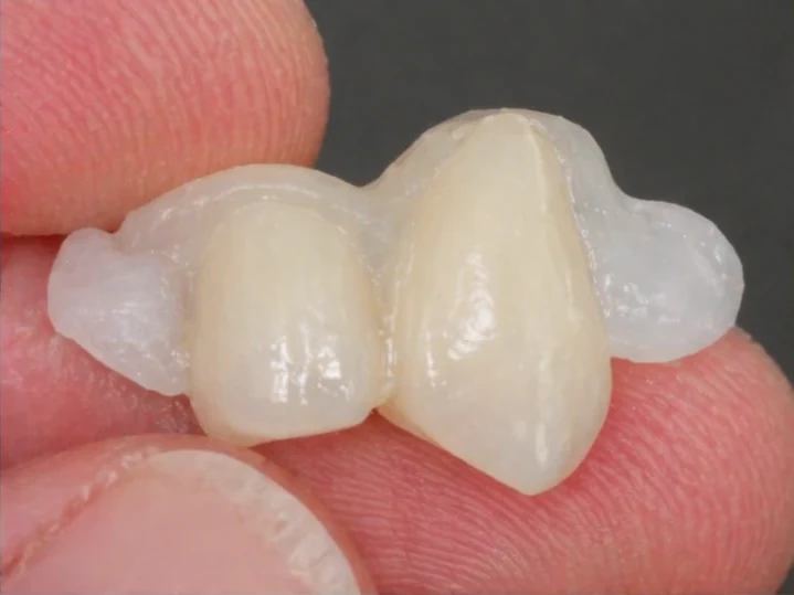 Hotová Denticor náhrada s dentálnymi korunkami v prispôsobiteľnom DentiFlex mostíku